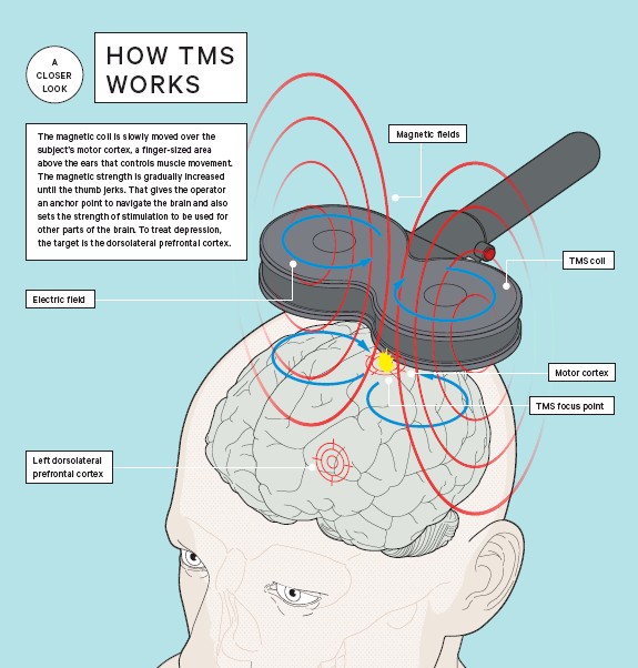 TMS (Magnets) Can Help Depression - Depression Help